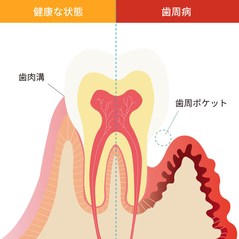 健康な歯茎と歯周病の歯茎