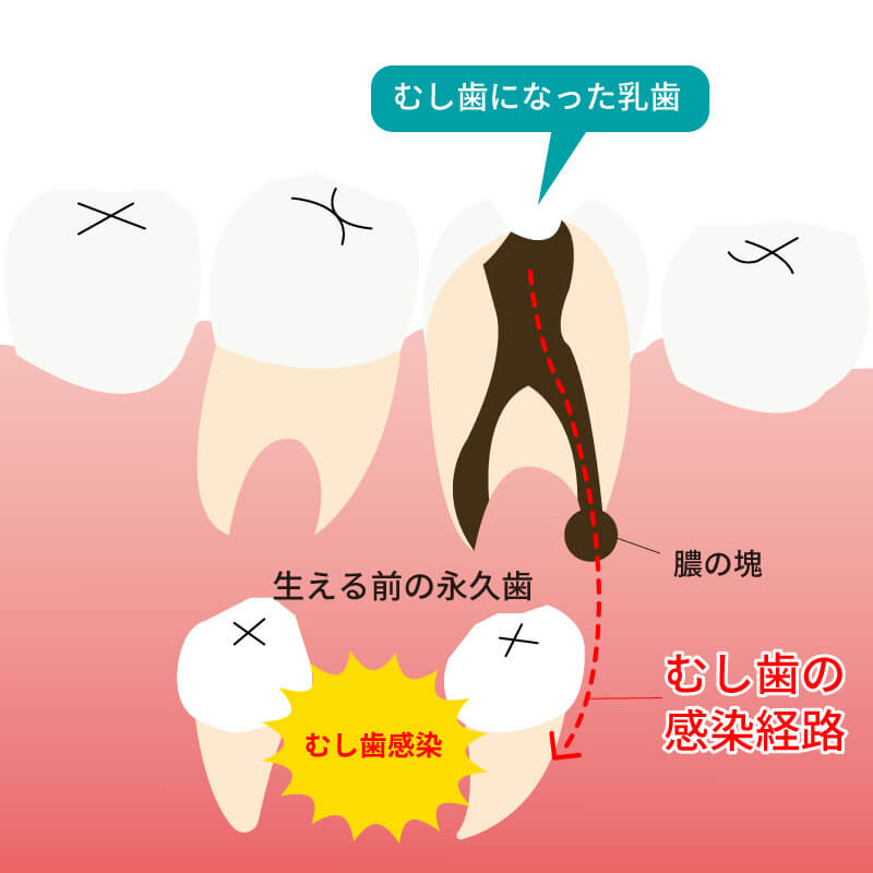 乳歯の虫歯