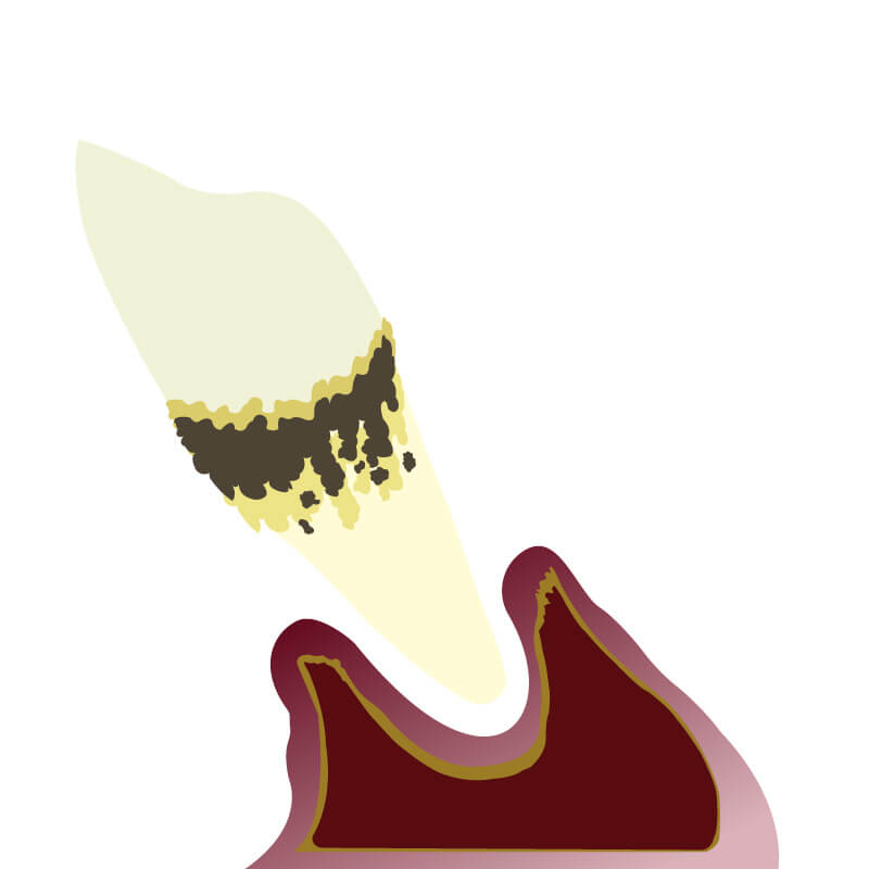 歯の脱落